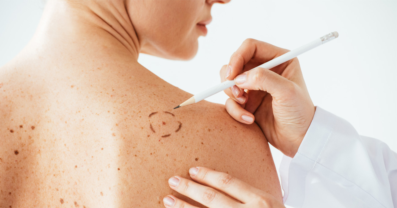 Clinical trial aims to determine optimal amount of skin to remove surrounding melanoma